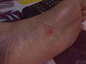 痒脚底视频,视频带你探索脚底瘙痒的奥秘